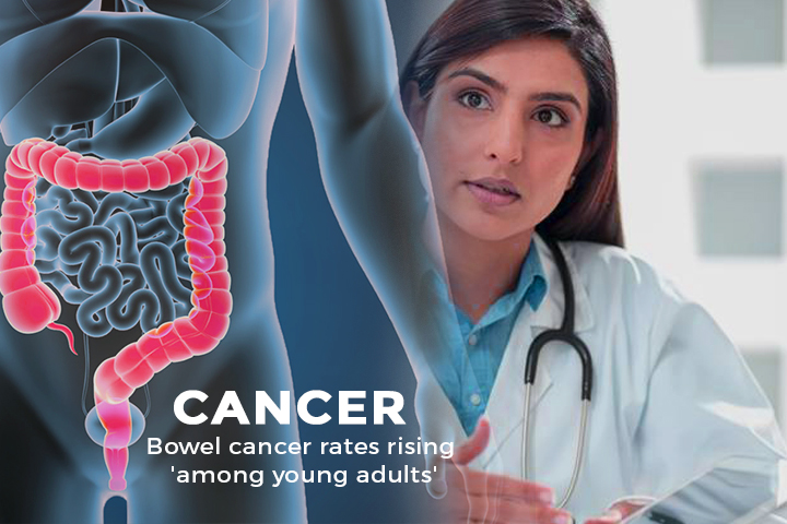 Rate of Bowel Cancer rising in Young Adults in European Countries